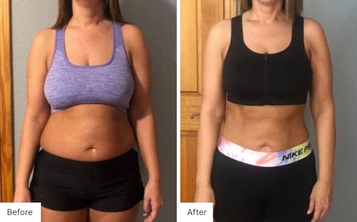 1 - Before and After of a woman's body using NeoraFit.