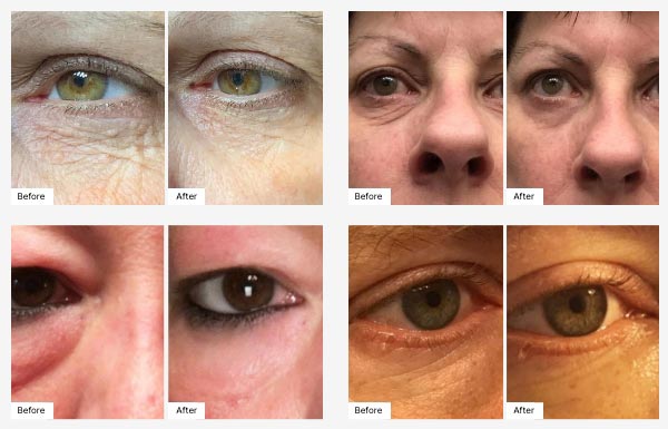 Images of actual customers' Before & After photos displaying their Real Results with Eye-V™ Moisture Boost Hydrogel Patches. 